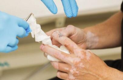 烫伤好了之后有白斑可能是白癜风吗 201704250924066332.jpg