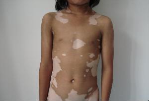 患上白癜风应该注意的东西 u=1714654821,313055201&fm=23&gp=0.jpg