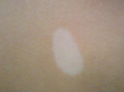 茄子擦白癜风有效果吗 u=338148545,624381464&fm=23&gp=0.jpg